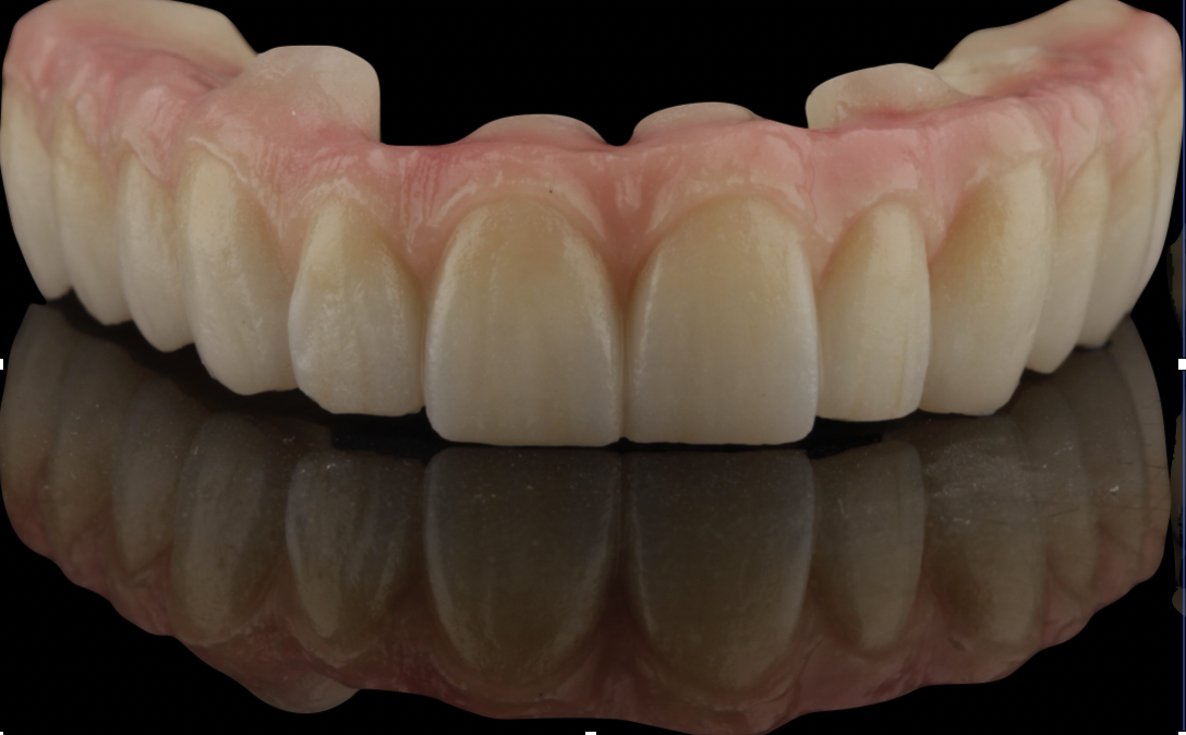 Rehabilitación oral completa sobre implantes en Carmay Madrid