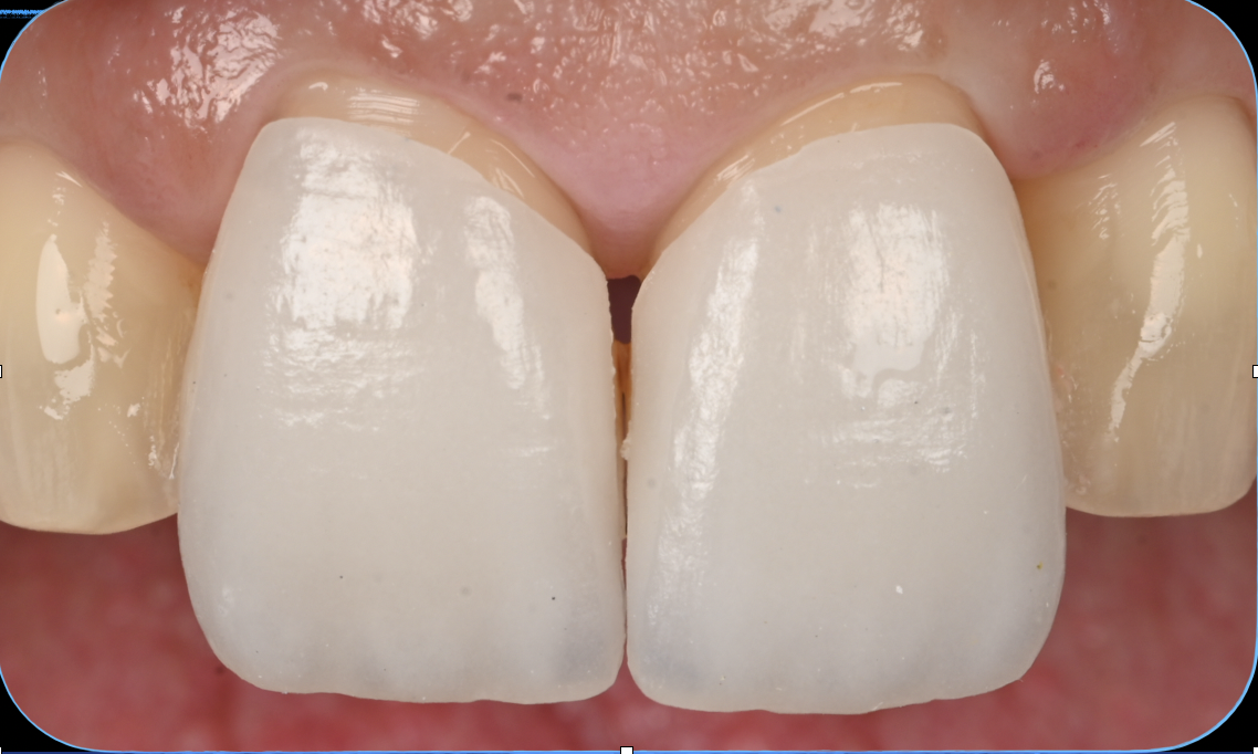 Estética dental premium en Carmay — carillas cerámicas Madrid
