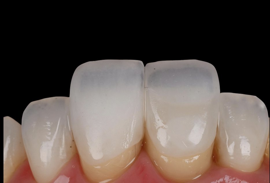 Carillas de porcelana estratificadas a mano — translucidez, halo y textura de un diente natural