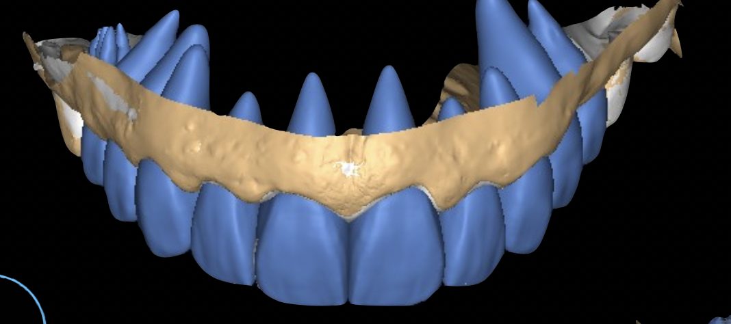 Diseño digital de la sonrisa CAD/CAM