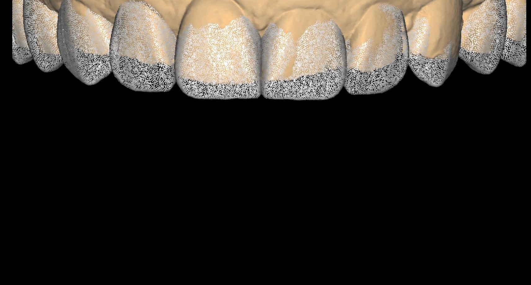 Diseño Digital de la Sonrisa — resultado personalizado en Carmay Madrid